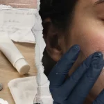 Crème eczéma visage : émollient SOS ou cortisone sur le visage